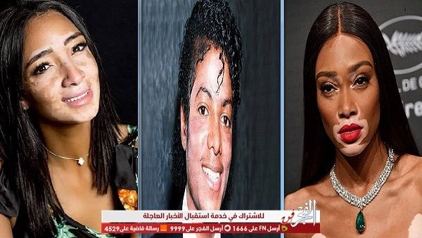 آخرهم رامي جمال.. مشاهير أصيبوا بمرض البهاق (صور)