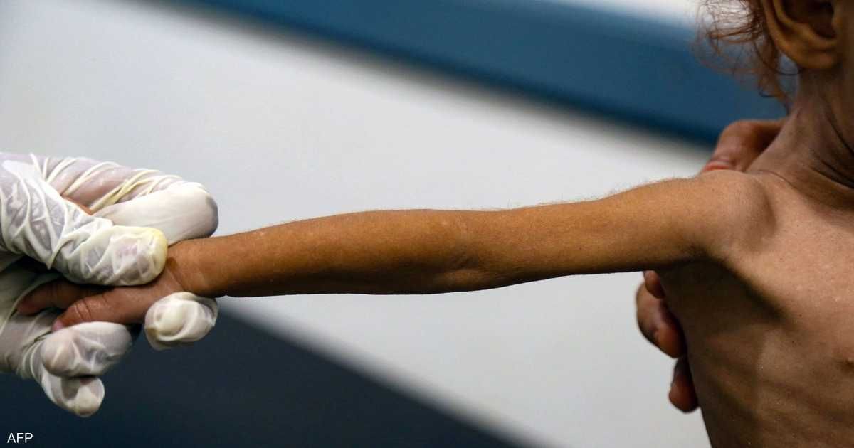 العالم اليوم - الأمم المتحدة: إصابة نحو 50 ألفا بالحصبة ووفاة 568 في اليمن