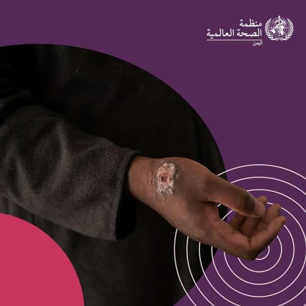 تحذير هام من الصحة العامة من خطر تفشي هذا المرض الخطير في اليمن