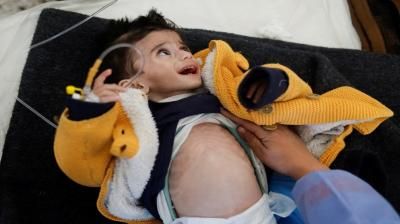 أخبار اليمن : ارتفاع شهداء سوء التغذية والجفاف بغزة إلى 23