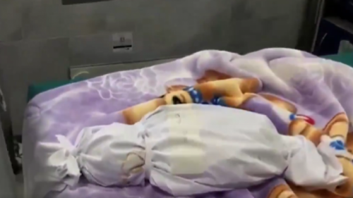 استشهاد طفلتين .. يرفع حصيلة ضحايا سوء التغذية في غزة