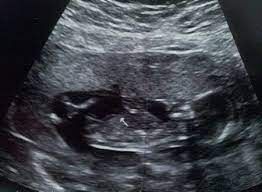 رفضت الأم اجهاض طفلتها بعدما رأتها كتلة سوداء بالسونار.. وبعد ولادتها كانت الصدمة! ..اتفرج