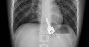 اتفرج الصدمة ..سعودي يبتلع مفتاح سيارته والسبب صادم لا يخطر على بال!