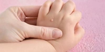 أخبار اليمن : طبيبة تحذر من خطر الثآليل عند الأطفال