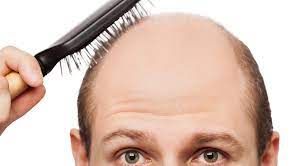 وداعاً للصلع وتساقط الشعر.. اكتشاف عشبة تحل جميع مشاكل الشعر بسرعة فائقة!!