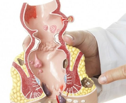 وصفة منزلية مذهلة تنهي آلام البواسير و بدون تدخل جراحي