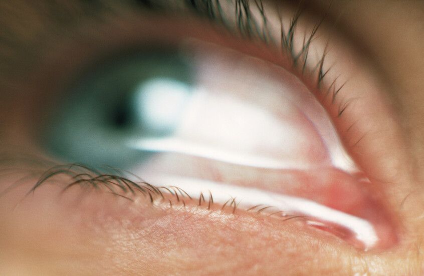 حالة نادرة تثير دهشة و حيرة الاطباء: "طفل يذرف دما بدلا من الدموع"!