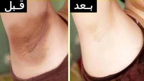 الوصفة الجهنمية لتبيض الجسم والمناطق الداكنة وعلاج الخطوط السيلوليت هتندهش من النتيجة