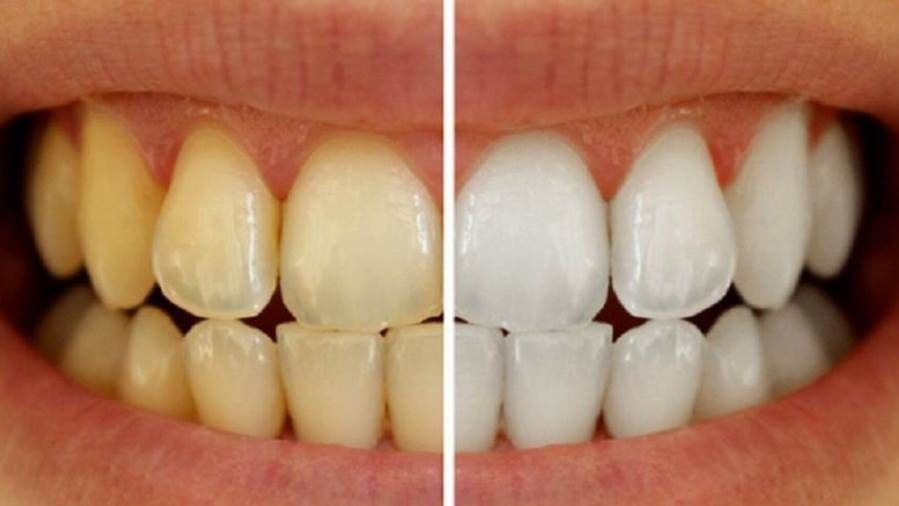 وصفة سحرية لإزالة جير الأسنان