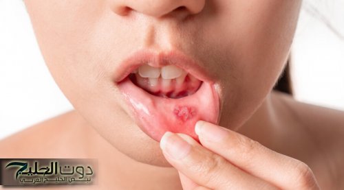 تخلص من إزعاج تقرحات الفم.. أسبابها وعلاجها.. هتتخلص منها في أقل وقت ممكن