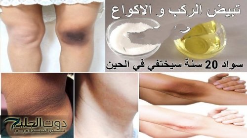 "السواد هيروح نهائيا".. اليكي افضل طريقة وافضل وصفة تقدري تشيلي بيها السواد من الركب والاكواع نهائيا.. مش هتشوفي سواد تاني!!