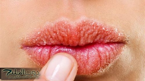 وداعًا للمعاناة.. وصفات طبيعية للتخلص من جفاف وتقشير الشفاه في الشتاء