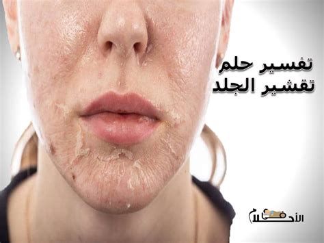 تفسير الاحتراق في المنام احترقت في الحلم