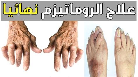 أفضل حبوب روماتيزم