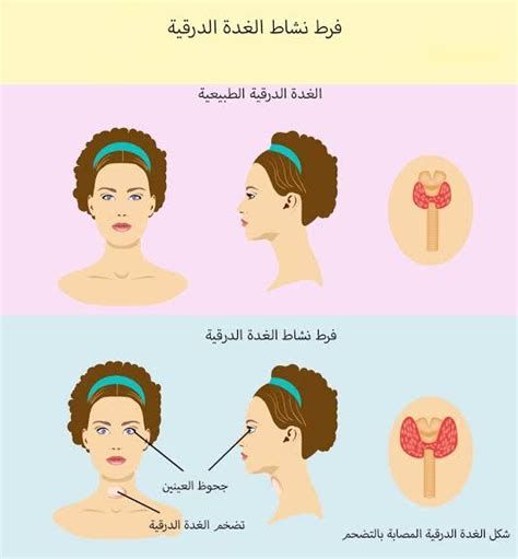 أعراض خلل الغدة الدرقية