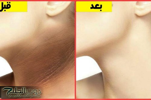 خلطة لتبيض الرقبة والابط من أول استخدام بمكونات طبيعية ومتوفرة