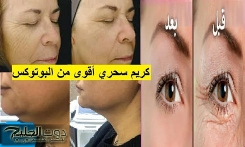 "منتجات البوتوكس والفيلر هتبقا برخص التراب لما سرها ينكشف!!".. معجزة الخميرة لنفخ الخدود وتسمين الوجه وتفتيح لون البشرة من اول مرة!!