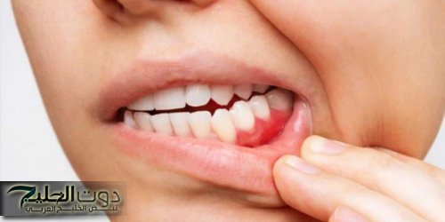 أعراض خطيرة للسرطان تلاحظ عند تنظيف الأسنان
