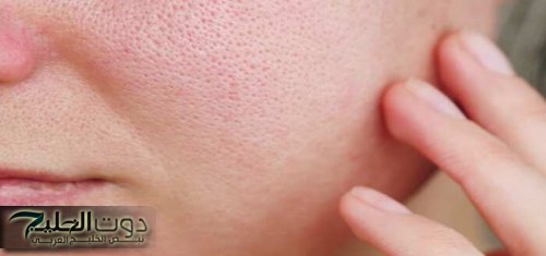 غلق مسام الوجه بطرق طبيعية بماسكات فعالة سهلة وسريعة التحضير منزليًا