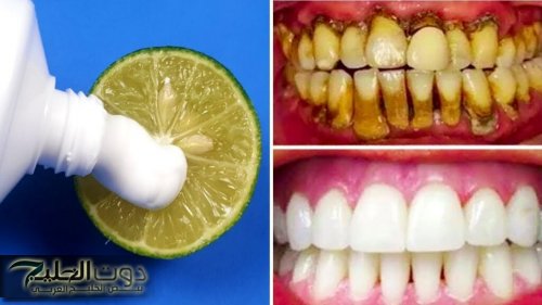 هتودعي إصفرار إسنانك من أول استخدام!!.. طرق طبيعيه لتبيض الأسنان وإزالة الأصفرار وبدون استخدام أي مبيضات