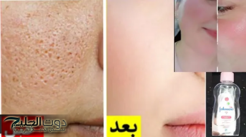 "مطلعش للاطفال بس"...إستخدمي زيت جونسون بهذة الطريقة وحلى أكبر مشكلة بتعاني منها