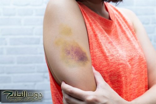 خطورة نزيف الأوعية الدموية تحت الجلد وتكون الكدمات