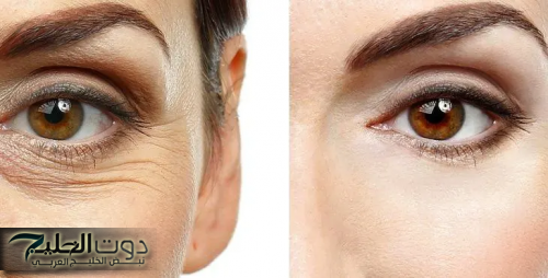 القناع السحري للتخلص من تجاعيد البشرة وعلامات التقدم في السن بوتوكس طبيعي