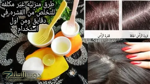 "انسى مشكلة قشرة الشعر والتساقط خالص".. طرق فعالة لعلاج قشرة الشعر وتساقطه بوصفات سهله وسريعة!!