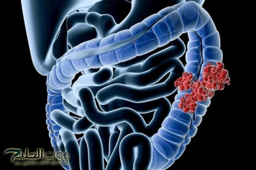 "كنز ثمين لا يقدر بثمن في كل بيت".. عشبة بسيطة تنظف القولون من البراز المتحجر والفضلات في دقائق معدودة دون الحاجة للطبيب!!