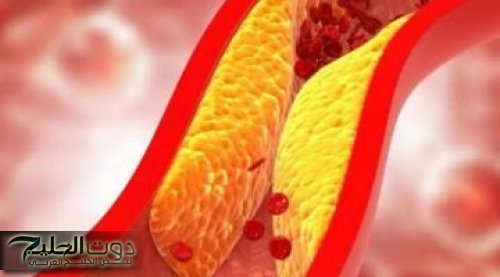 خلي بالك من صحتك!!... 4 علامات تدل على ارتفاع الكوليسترول في الدم... تعرف عليها بسرعة!!
