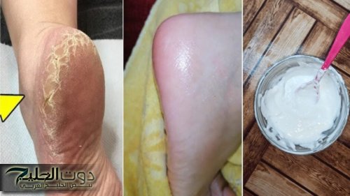 "هتبقا انعم من رجل البيبي!"... طريقة جهنمية للتخلص من تشقق القدمين نهائياً... هتشوفي نعومة جبارة!!