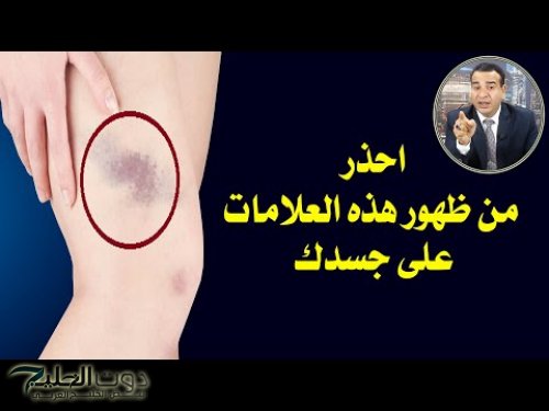 "تحذير عاجل للنســاء".. إذا ظهرت هذه العلامات على جسدك فقد تكون دليلاً خطيراً على الإصابة بمرض القلب القاتل.. لا تهمليها أبدًا!!