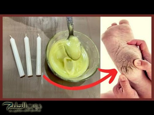 "هتحقق حلم حياتك" … شمعة واحدة فقط وتخلص من تشققات القدمين نهائيًا ومن أول استخدام كعوب وقدمين وجلد مثل ملمس الحرير