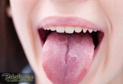 " علامات غريبة في فمك".... ممكن تكشف عن نقص خطير في جسمك وانت مش واخد بالك