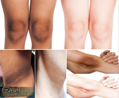 «هتنوري في الضلمة!!»..تفتيح المناطق الداكنة والسوداء سواد السنين والبشرة 5 درجات في يومين فقط بدون كريمات او عمليات!!