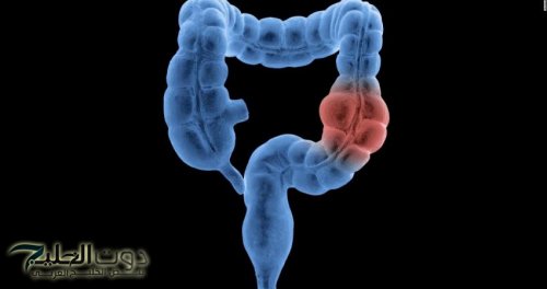 "طريقة طبيعية لتنظيف القولون بسرعة".. عشبة مذهلة تجدها في مطبخك