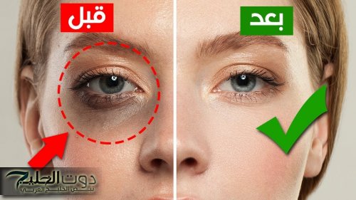 وصفات طبيعية لإزالة الهالات السوداء تحت العين في أسرع وقت
