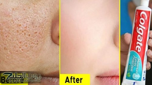 كريم ازالة اثار الحبوب من الوجه بسرعة والتخلص من البقع الداكنة والتصبغات نهائيا من أول استعمال