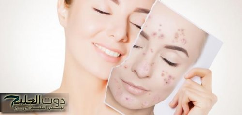 القناع الطبيعي السحري للقضاء على التصبغ البقع وآثار حب الشباب والنتيجة مدهشة