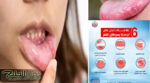 يتجاهلها كثيرون.. طبيب أسنان يكشف 7 علامات تحذيرية مبكرة لسرطان الفم خلي بالك منها الموضوع مافيهوش هزار حياتك في خطر!!!