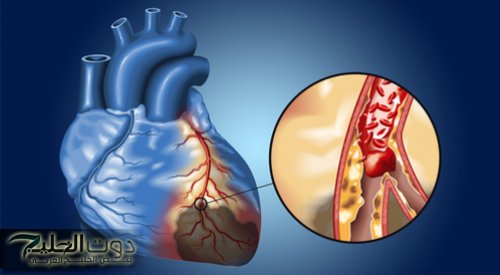 احذر.. 7 علامات تشير إلى انسداد شرايين القلب وتعرضك للموت المفاجئ .. الأخيرة تظهر قبل شهر من الإصابة