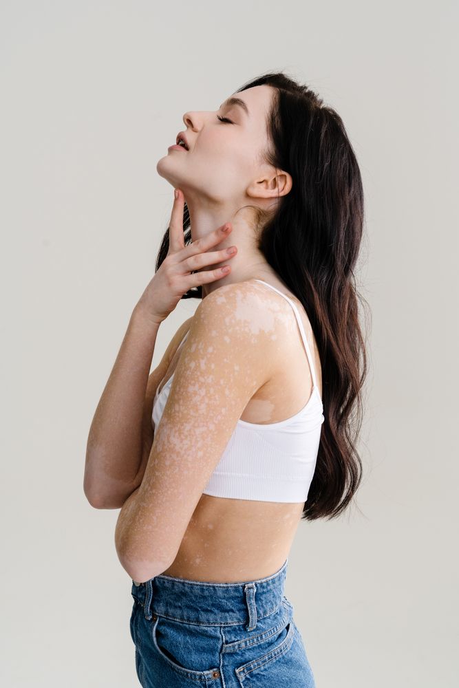 بكتيريا معوية مفيدة.. قد تحمل الأمل لمرضى البهاق: إليكِ التفاصيل