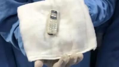 أخبار اليمن : فريق طبي يستخرج هاتفاً من معدة مريض