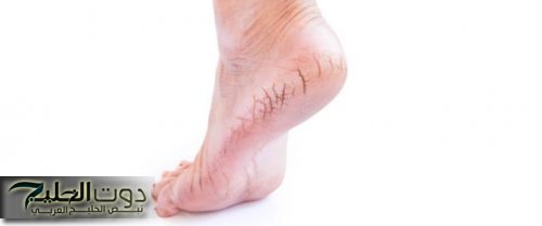 «ما فيش أسهل من كده».. ملعقتان خل وفي يوم واحد هتتخلصي من تشققات الكعبيين وتصبغات القدمين