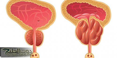 حبس البول مش بطولة!!.. ده إعلان مجاني عن إنك محتاجة تنظيم حياتك من أول وجديد!!