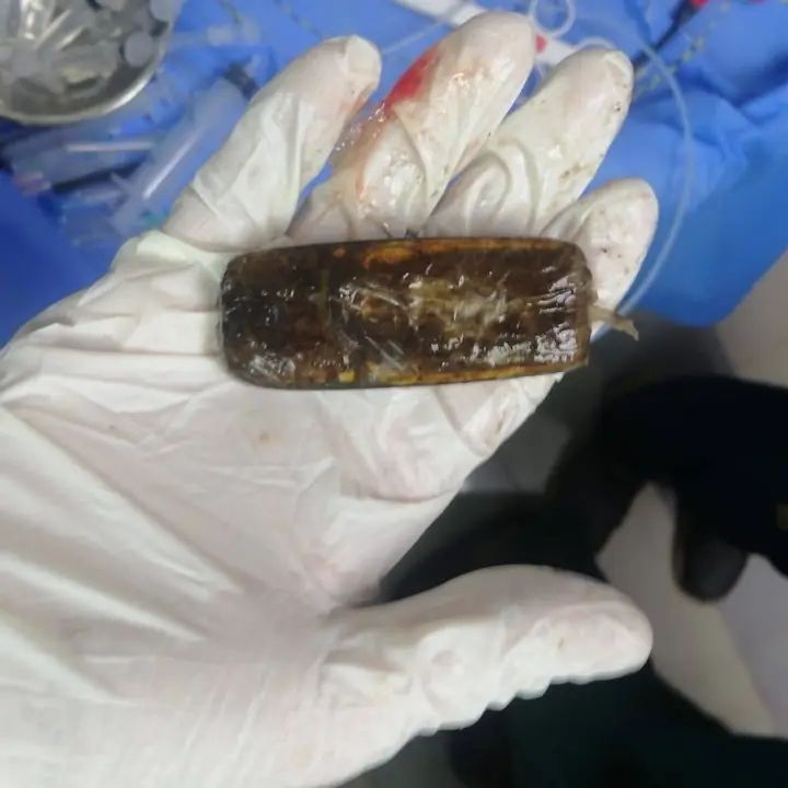 بعد عامين من الألم.. طب الأزهر بأسيوط يُنهي معاناة سجين ابتلع هاتفا