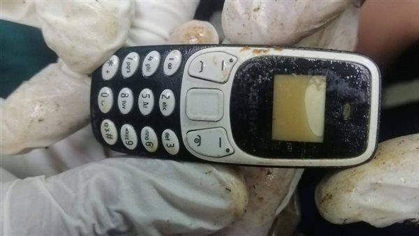 استخرجوا موبايل من معدة مريض بعد سنتين من ابتلاعه بمستشفى اسيوط