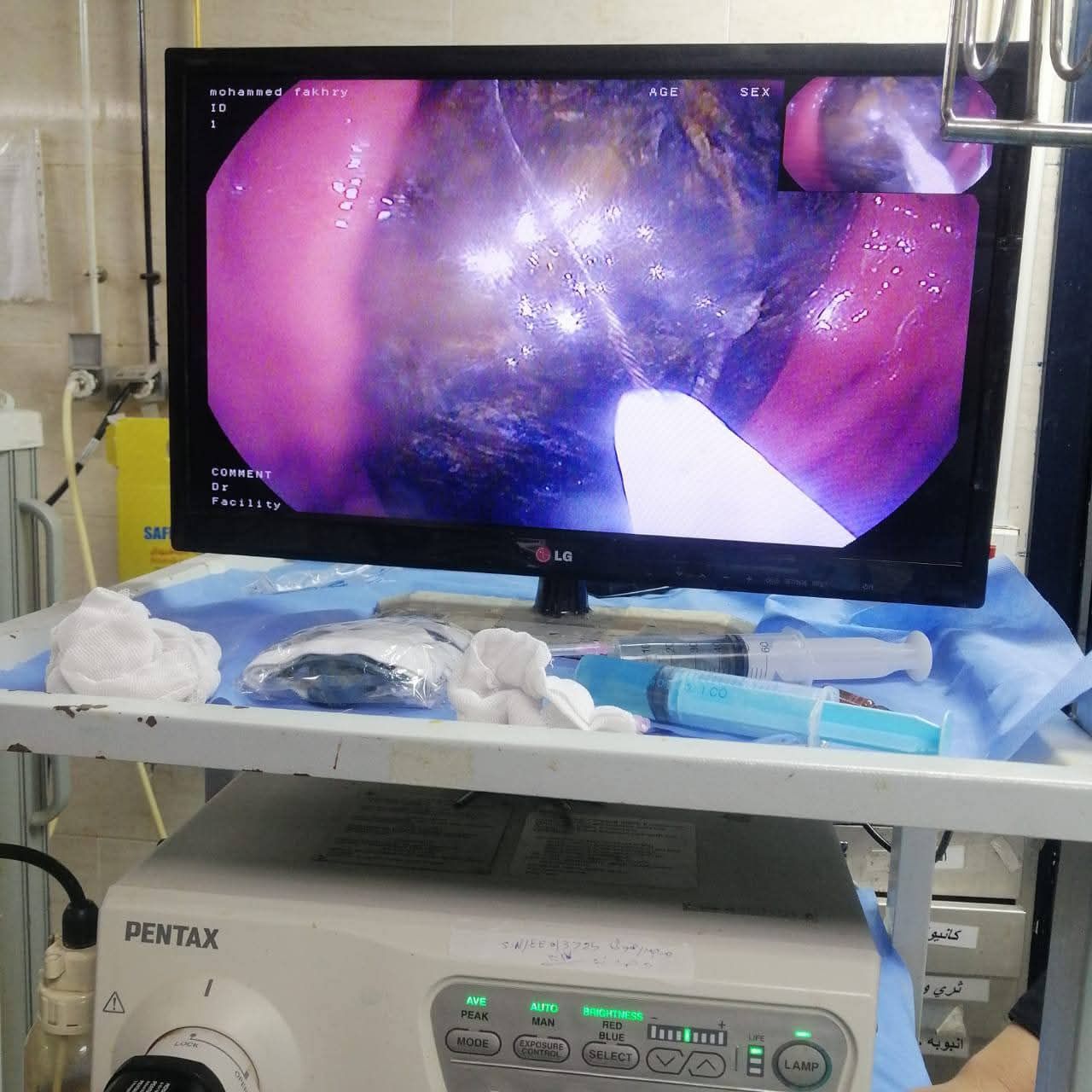 استخرجوا موبايل من معدة مريض بعد سنتين من ابتلاعه بمستشفى اسيوط