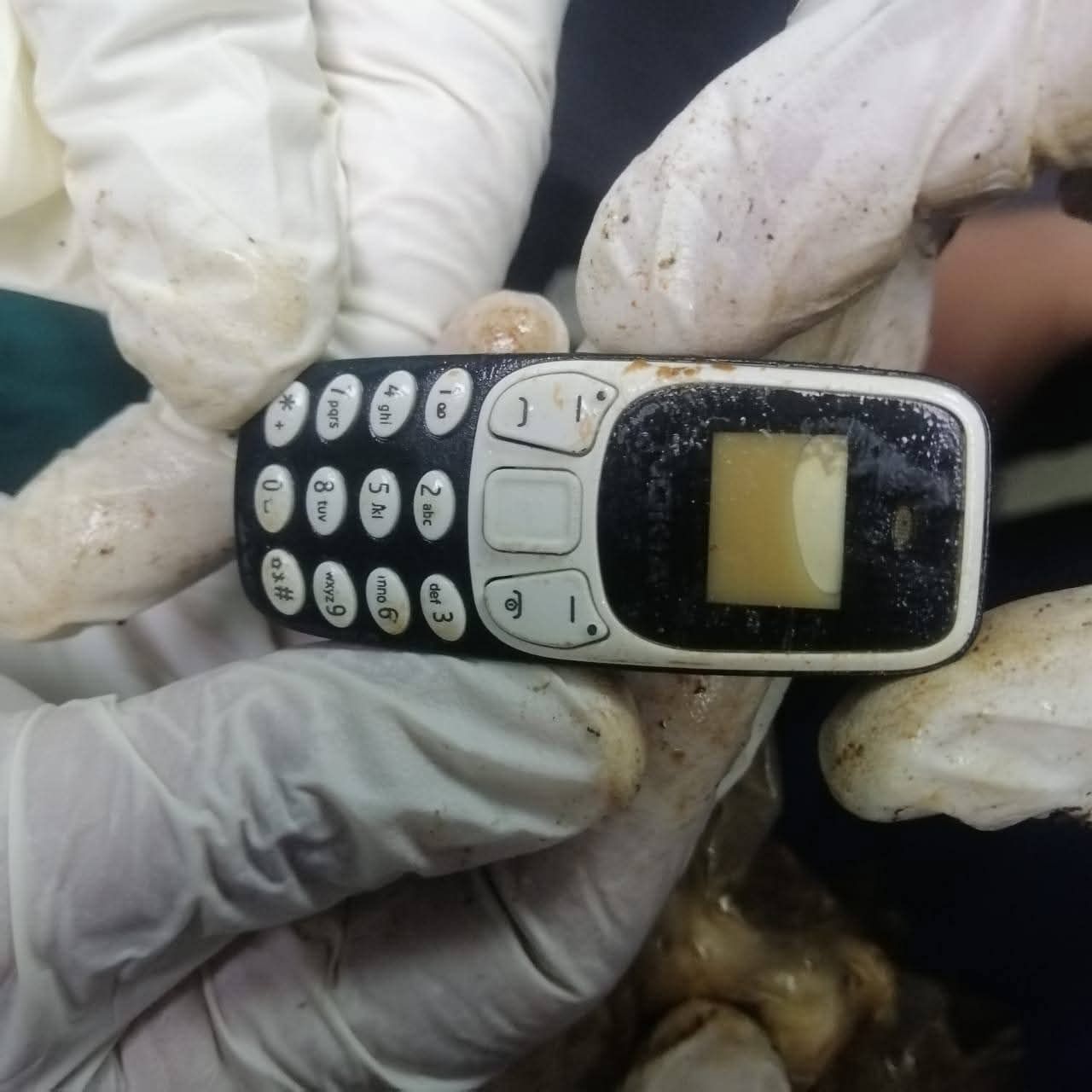 استخرجوا موبايل من معدة مريض بعد سنتين من ابتلاعه بمستشفى اسيوط