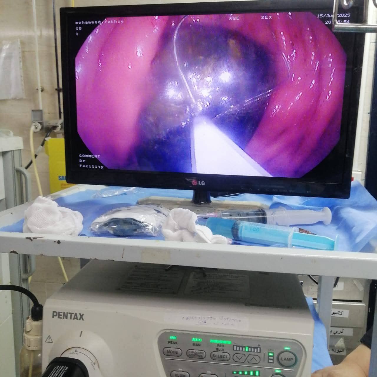 استخرجوا موبايل من معدة مريض بعد سنتين من ابتلاعه بمستشفى اسيوط